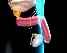 無精癥治療方法“助您告別無精時代”